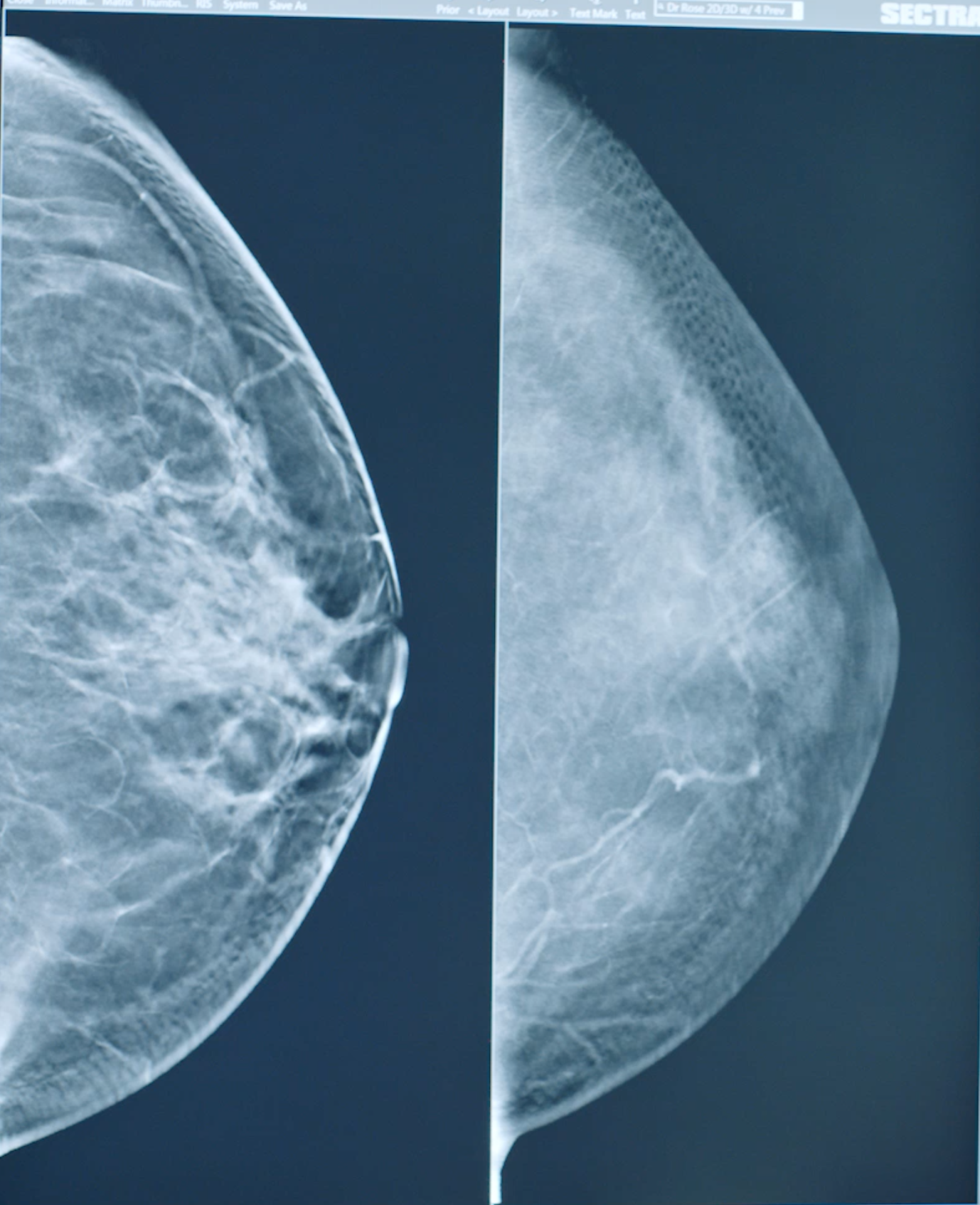 Small breast cancer, Radiology Case