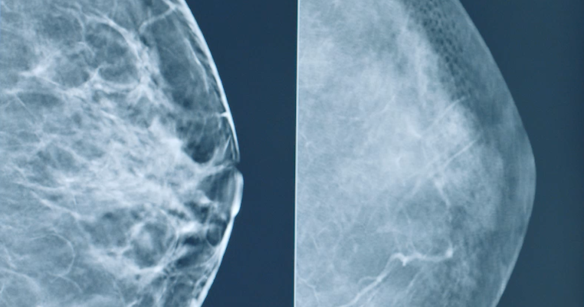 What Are Fibrocystic Breasts Solis Mammography what-are-fibrocystic-breasts-solis-mammography